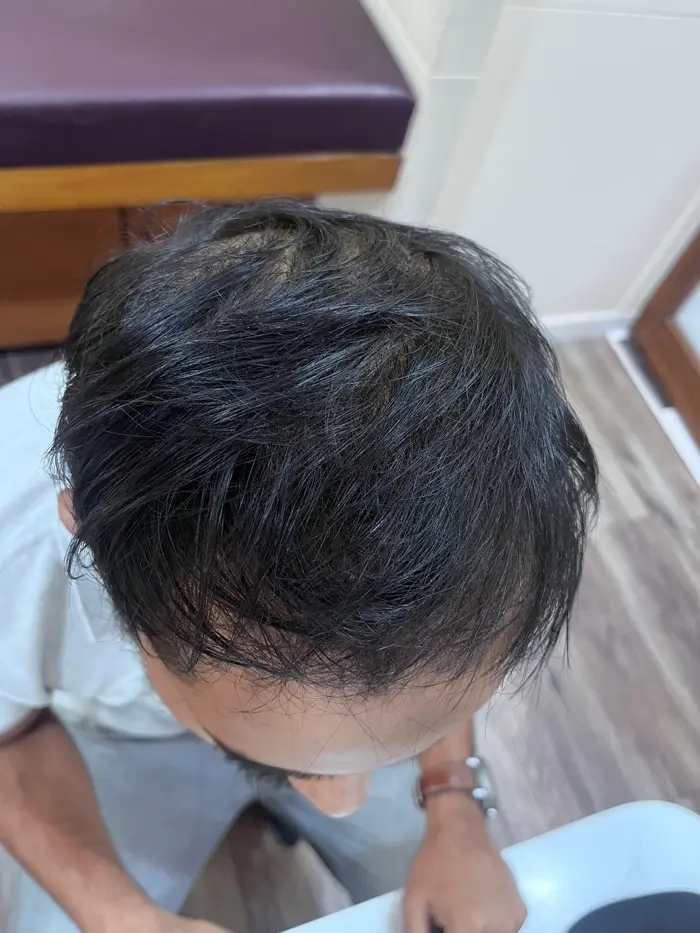 Male Pattern Baldness case 2 after treatment